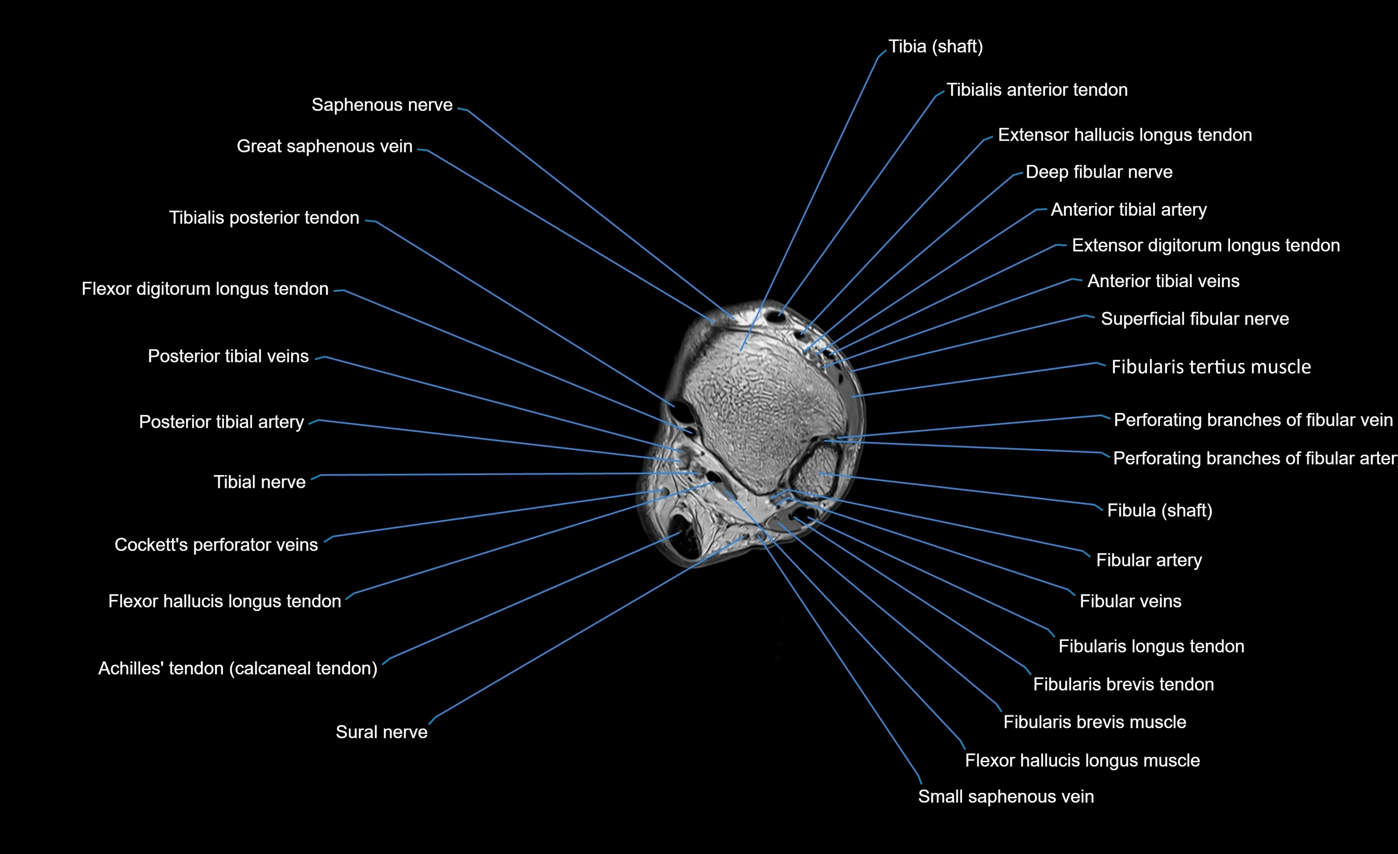 MRI lower leg axial cross sectional anatomy 3T  radiology  image-img-00001-00098.webp